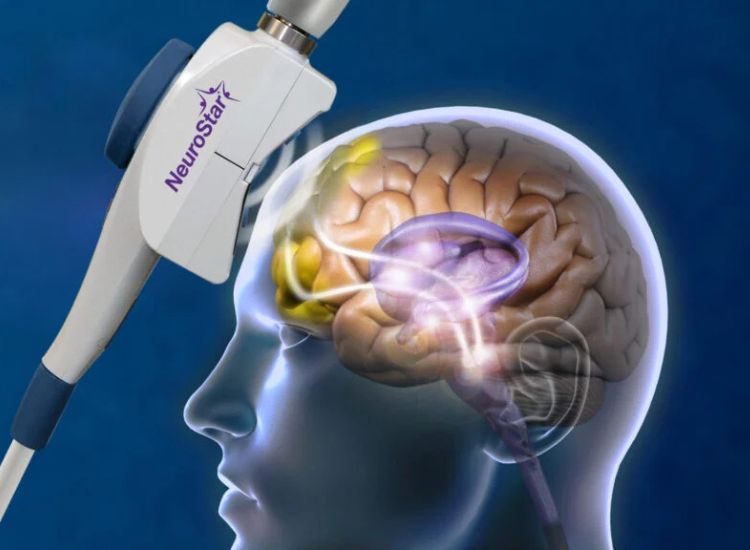 How TMS Therapy Is Transforming Depression Treatment: A Non‑Invasive Alternative to Medication