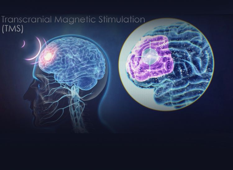 Illustration of Transcranial Magnetic Stimulation (TMS) showing a side profile of a human head with a glowing brain region and a magnified view of targeted neural stimulation. The image highlights the precision and non-invasive nature of TMS therapy used in treating depression.