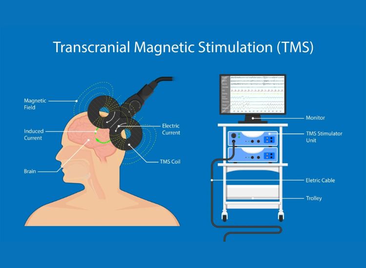 Diagram and equipment overview of Transcranial Magnetic Stimulation (TMS), showing how a magnetic field from a coil induces electric currents in the brain to stimulate neural activity. Includes labeled components such as TMS Coil, Magnetic Field, Induced Current, and a clinical setup with monitor, stimulator unit, and trolley.