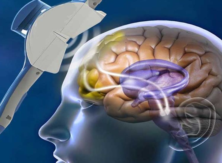 Graphical illustration of Transcranial Magnetic Stimulation (TMS) applied to a human head, showing a device emitting waves toward the semi-transparent brain with highlighted internal structures like the cerebral cortex and deep purple regions representing the thalamus or basal ganglia.