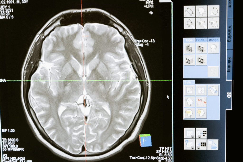 Axial MRI scan of a human brain showing cerebral cortex, white matter, and ventricles, with red and green reference lines and interface annotations.